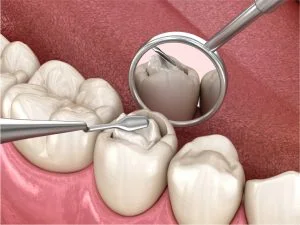 Dental bonding before and after result at iCare in Norcross, GA